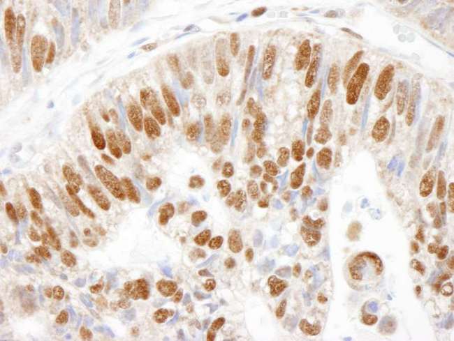 MCM3 Antibody - Detection of Human MCM3 by Immunohistochemistry. Sample: FFPE section of human colon carcinoma. Antibody: Affinity purified rabbit anti-MCM3 used at a dilution of 1:1000 (1 Detection: DAB.