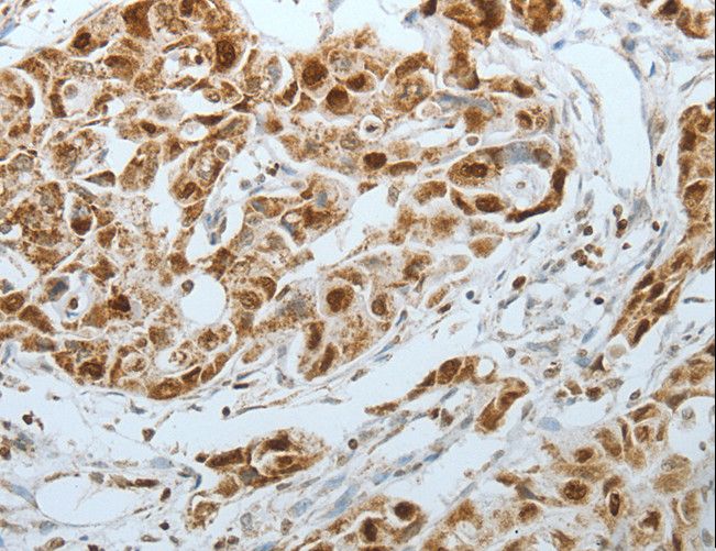 MCM3 Antibody - Immunohistochemistry of paraffin-embedded Human lung cancer using MCM3 Polyclonal Antibody at dilution of 1:25.