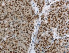 MCM3 Antibody - Immunohistochemistry of paraffin-embedded Human liver cancer using MCM3 Polyclonal Antibody at dilution of 1:30.