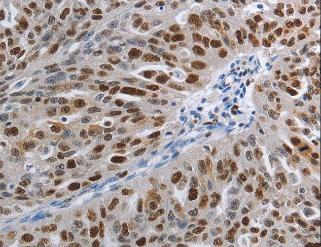MCM3 Antibody - Immunohistochemistry of paraffin-embedded Human ovarian cancer using MCM3 Polyclonal Antibody at dilution of 1:30.
