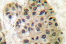 MCM3AP / GANP Antibody - IHC of GANP/MCM3AP (E1872) pAb in paraffin-embedded human breast carcinoma tissue.