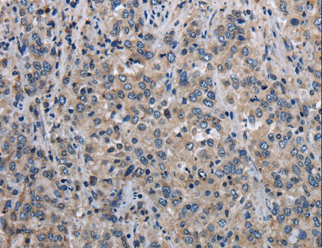 MCM3AP / GANP Antibody - Immunohistochemistry of paraffin-embedded Human liver cancer using MCM3AP Polyclonal Antibody at dilution of 1:30.