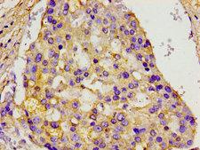 MCM3AP / GANP Antibody - Immunohistochemistry image of paraffin-embedded human breast cancer at a dilution of 1:100