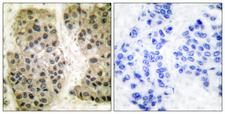 MCM3AP / GANP Antibody - Peptide - + Immunohistochemical analysis of paraffin-embedded human breast carcinoma tissue using GANP antibody.