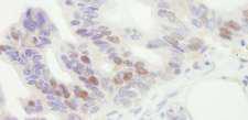 MCM4 Antibody - Detection of Human MCM4 by Immunohistochemistry. Sample: FFPE section of human ovarian carcinoma. Antibody: Affinity purified goat anti-MCM4 used at a dilution of 1:1000 (1 Detection: DAB.