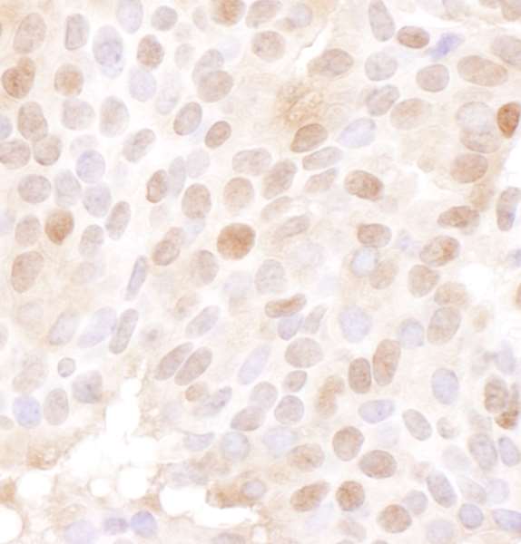 MCM4 Antibody - Detection of human MCM4 by immunohistochemistry. Sample: FFPE section of human ovarian carcinoma. Antibody: Affinity purified goat anti-MCM4 used at a dilution of 1:1,000 (1µg/ml). Detection: DAB