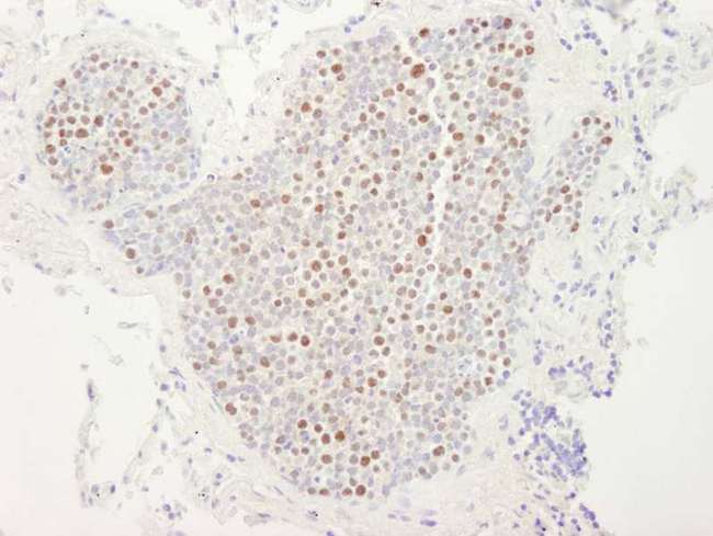 MCM4 Antibody - Detection of Human MCM4 by Immunohistochemistry. Sample: FFPE section of human lung small cell carcinoma. Antibody: Affinity purified rabbit anti-MCM4 used at a dilution of 1:250. Detection: DAB.