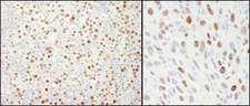MCM4 Antibody - Detection of Human and Mouse MCM4 by Immunohistochemistry. Sample: FFPE section of human testicular seminoma (left) and mouse squamous cell carcinoma (right). Antibody: Affinity purified rabbit anti-MCM4 used at a dilution of 1:1000 (1 Detection: DAB.