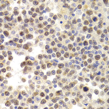 MCM4 Antibody - Immunohistochemistry of paraffin-embedded human B cell lymphoma tissue.