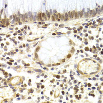 MCM4 Antibody - Immunohistochemistry of paraffin-embedded human stomach cancer tissue.