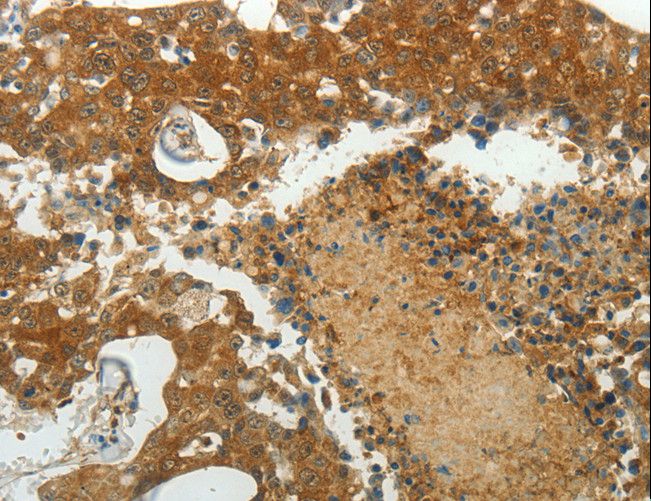 MCM4 Antibody - Immunohistochemistry of paraffin-embedded Human breast cancer using MCM4 Polyclonal Antibody at dilution of 1:40.
