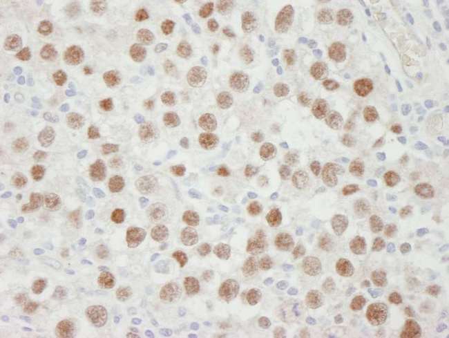 MCM5 Antibody - Detection of Human MCM5 by Immunohistochemistry. Sample: FFPE section of human seminoma. Antibody: Affinity purified rabbit anti-MCM5 used at a dilution of 1:250. Detection: DAB.