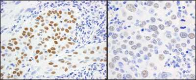 MCM5 Antibody - Detection of Human and Mouse MCM5 by Immunohistochemistry. Sample: FFPE sections of human lung carcinoma (left) and mouse renal cell carcinoma (right). Antibody: Affinity purified rabbit anti-MCM5 used at a dilution of 1:1000 (1 ug/ml). Detection: DAB.