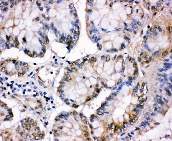 MCM5 Antibody - MCM5 antibody. IHC(P): Human Intestinal Cancer Tissue.
