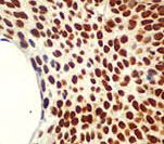 MCM5 Antibody - IHC of MCM5 on FFPE Cervical Cancer tissue. This image was taken for the unmodified form of this product. Other forms have not been tested.