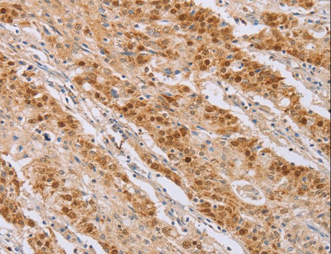 MCM5 Antibody - Immunohistochemistry of paraffin-embedded Human gastric cancer using MCM5 Polyclonal Antibody at dilution of 1:40.
