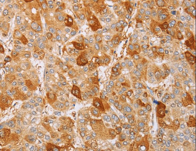 MCM5 Antibody - Immunohistochemistry of paraffin-embedded Human liver cancer using MCM5 Polyclonal Antibody at dilution of 1:40.