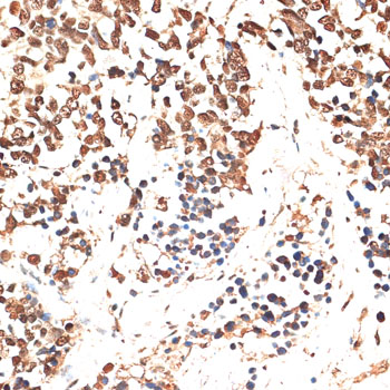 MCM5 Antibody - Immunohistochemistry of paraffin-embedded human lung cancer using MCM5 antibody at dilution of 1:100 (40x lens).
