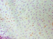 MCM6 Antibody - Immunohistochemistry of paraffin-embedded human cervical cancer using antibody at 1:100 dilution.