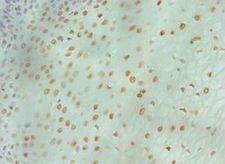 MCM6 Antibody - Immunohistochemistry of paraffin-embedded human cervical cancer using antibody at 1:100 dilution.