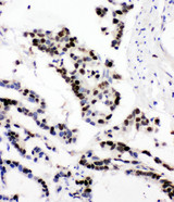 MCM6 Antibody - MCM6 antibody. IHC(P): Human Intestinal Cancer Tissue.