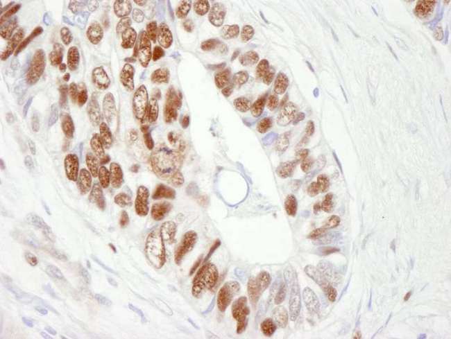 MCM6 Antibody - Detection of Human MCM6 by Immunohistochemistry. Sample: FFPE section of human colon adenocarcinoma. Antibody: Affinity purified goat anti-MCM6 used at a dilution of 1:250. Detection: DAB.