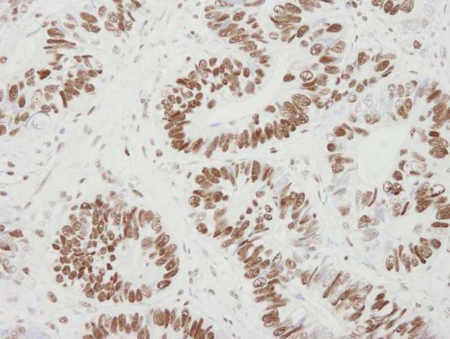 MCM6 Antibody - Detection of Human MCM6 by Immunohistochemistry. Sample: FFPE section of human colon adenocarcinoma. Antibody: Affinity purified rabbit anti-MCM6 used at a dilution of 1:250. Detection: DAB.