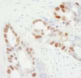MCM6 Antibody - Detection of Human MCM6 by Immunohistochemistry. Sample: FFPE section of human ovarian carcinoma. Antibody: Affinity purified goat anti-MCM6 used at a dilution of 1:1000 (1 Detection: DAB.