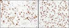 MCM6 Antibody - Detection of Human and Mouse MCM6 by Immunohistochemistry. Sample: FFPE section of human breast carcinoma (left) and mouse squamous cell carcinoma (right). Antibody: Affinity purified rabbit anti-MCM6 used at a dilution of 1:1000 (1 Detection: DAB.