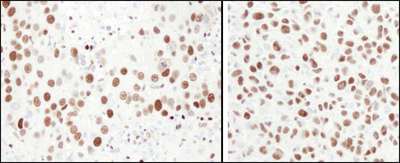 MCM6 Antibody - Detection of Human and Mouse MCM6 by Immunohistochemistry. Sample: FFPE section of human breast carcinoma (left) and mouse squamous cell carcinoma (right). Antibody: Affinity purified rabbit anti-MCM6 used at a dilution of 1:1000 (1 Detection: DAB.