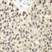 MCM6 Antibody - Immunohistochemistry of paraffin-embedded human lung cancer tissue.