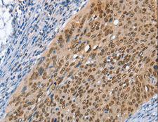 MCM6 Antibody - Immunohistochemistry of paraffin-embedded Human cervical cancer using MCM6 Polyclonal Antibody at dilution of 1:45.