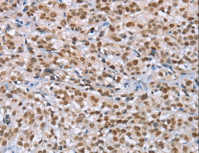 MCM6 Antibody - Immunohistochemistry of paraffin-embedded Human esophagus cancer using MCM6 Polyclonal Antibody at dilution of 1:60.