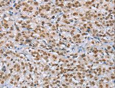 MCM6 Antibody - Immunohistochemistry of paraffin-embedded Human esophagus cancer using MCM6 Polyclonal Antibody at dilution of 1:60.