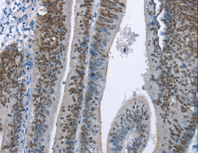 MCM6 Antibody - Immunohistochemistry of paraffin-embedded Human colon cancer using MCM6 Polyclonal Antibody at dilution of 1:60.
