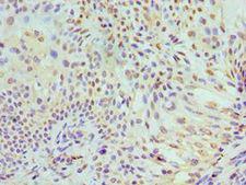 MCM7 Antibody - Immunohistochemistry of paraffin-embedded human breast cancer using antibody at 1:100 dilution.
