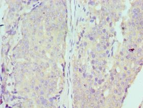 MCM7 Antibody - Immunohistochemistry of paraffin-embedded human rectal cancer using antibody at 1:100 dilution.