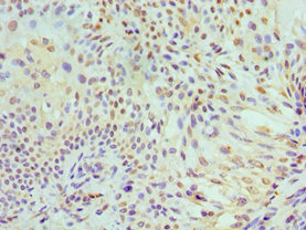 MCM7 Antibody - Immunohistochemistry of paraffin-embedded human breast cancer using MCM7 Antibody at dilution of 1:100