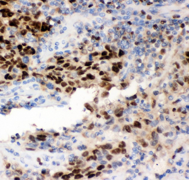 MCM7 Antibody - MCM7 antibody IHC-paraffin: Human Lung Cancer Tissue.