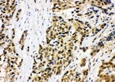 MCM7 Antibody - MCM7 antibody. IHC(P): Human Lung Cancer Tissue.
