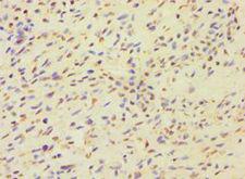 MCMBP / C10orf119 Antibody - Immunohistochemistry of paraffin-embedded human breast cancer using antibody at 1:100 dilution.