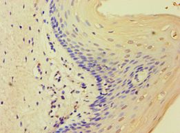 MCMBP / C10orf119 Antibody - Immunohistochemistry of paraffin-embedded human cervical cancer using antibody at 1:100 dilution.