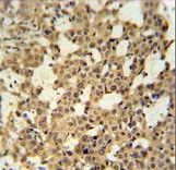 MCMBP / C10orf119 Antibody - CJ119 Antibody immunohistochemistry of formalin-fixed and paraffin-embedded human cervix carcinoma tissue followed by peroxidase-conjugated secondary antibody and DAB staining.