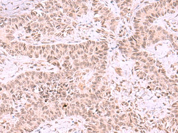 MCMBP / C10orf119 Antibody - Immunohistochemistry of paraffin-embedded Human ovarian cancer tissue  using MCMBP Polyclonal Antibody at dilution of 1:35(×200)