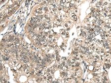 MCPH1 Antibody - Immunohistochemistry of paraffin-embedded Human gastric cancer tissue  using MCPH1 Polyclonal Antibody at dilution of 1:110(×200)