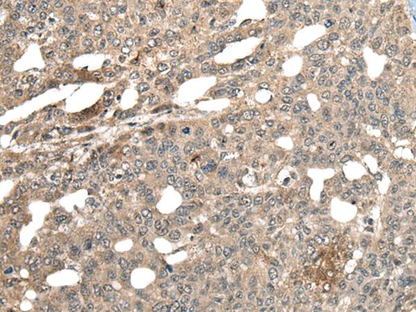 MCPH1 Antibody - Immunohistochemistry of paraffin-embedded Human liver cancer tissue  using MCPH1 Polyclonal Antibody at dilution of 1:110(×200)