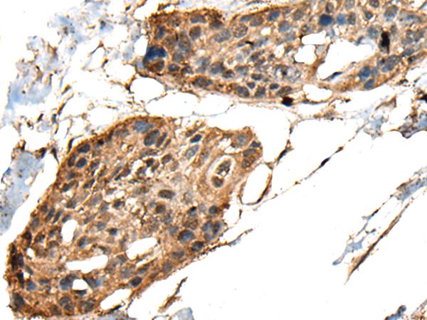 MCPH1 Antibody - Immunohistochemistry of paraffin-embedded Human esophagus cancer tissue  using MCPH1 Polyclonal Antibody at dilution of 1:40(×200)