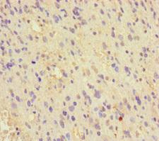 MCRS1 / MSP58 Antibody - Immunohistochemistry of paraffin-embedded human glioma cancer at dilution of 1:100