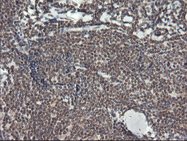 MCTS1 Antibody - IHC of paraffin-embedded Human lymphoma tissue using anti-MCTS1 mouse monoclonal antibody.