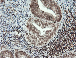 MCTS1 Antibody - IHC of paraffin-embedded Adenocarcinoma of Human endometrium tissue using anti-MCTS1 mouse monoclonal antibody. (Heat-induced epitope retrieval by 10mM citric buffer, pH6.0, 100C for 10min).